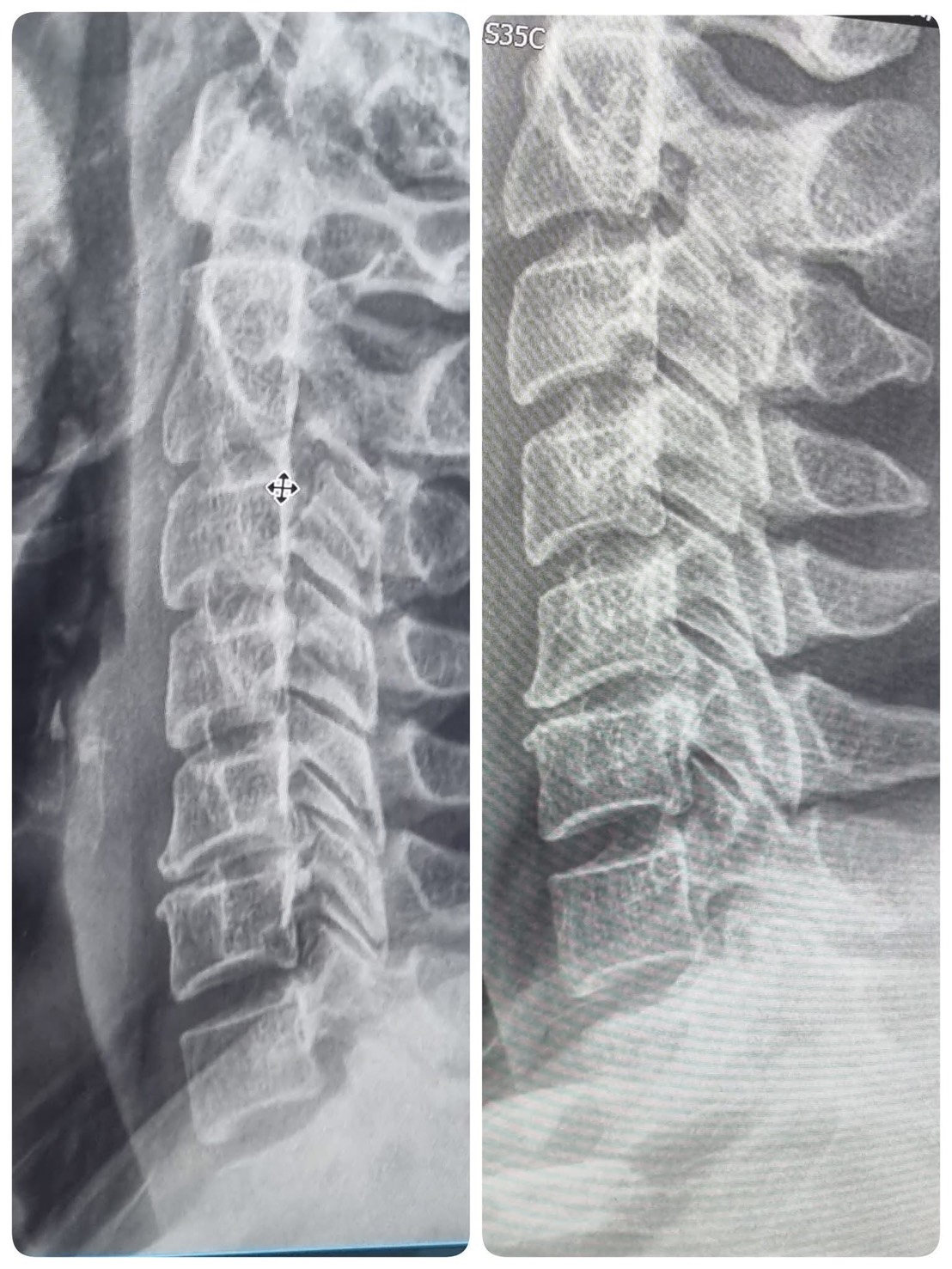 กระดูกสันหลังคด (Scoliosis) สังเกตอย่างไร และรักษาได้ไหม?